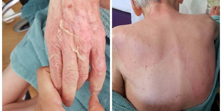 Bakım evinde ölümde rapor çıktı: Hastalık yok, yanık oluşmuş